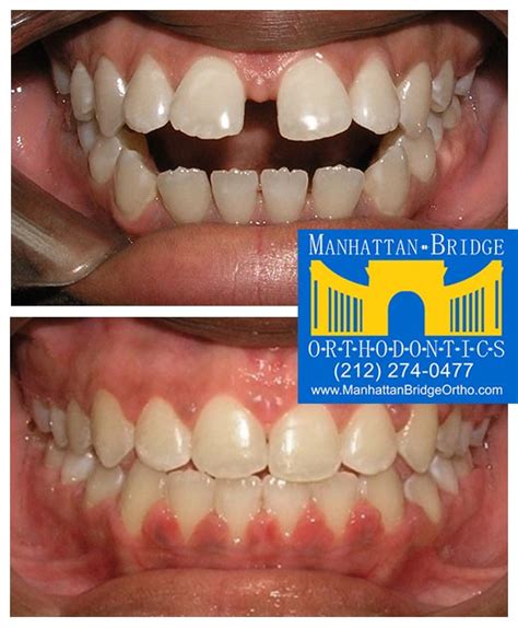 Manhattan bridge orthodontics. Things To Know About Manhattan bridge orthodontics. 